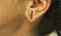 ear-1-before