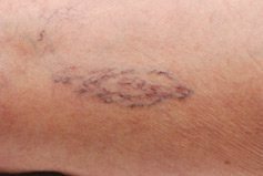 sclerotherapy-pre-case-1