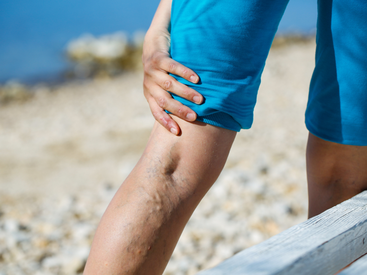 What are the best varicose vein treatment options?