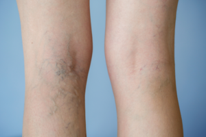 How_Can_You_Get_Rid_of_Varicose_Veins_on_Your_Legs_637751823753090423