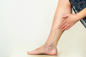 Varicose_Veins_Treatment_What_Should_You_Expect_638163075156556263