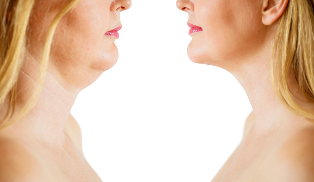 Is_Kybella_an_Effective_Solution_for_Reducing_Double_Chin_638454671324799470