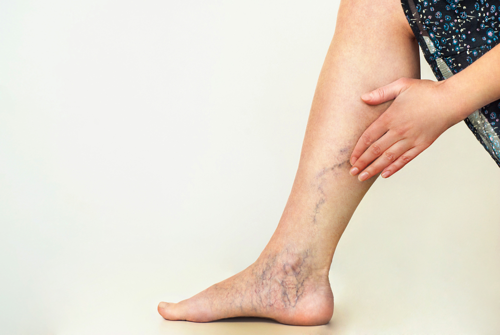 Varicose Veins Treatment