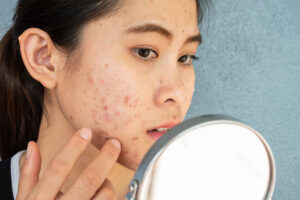 acne-in-adults-worcester-derm